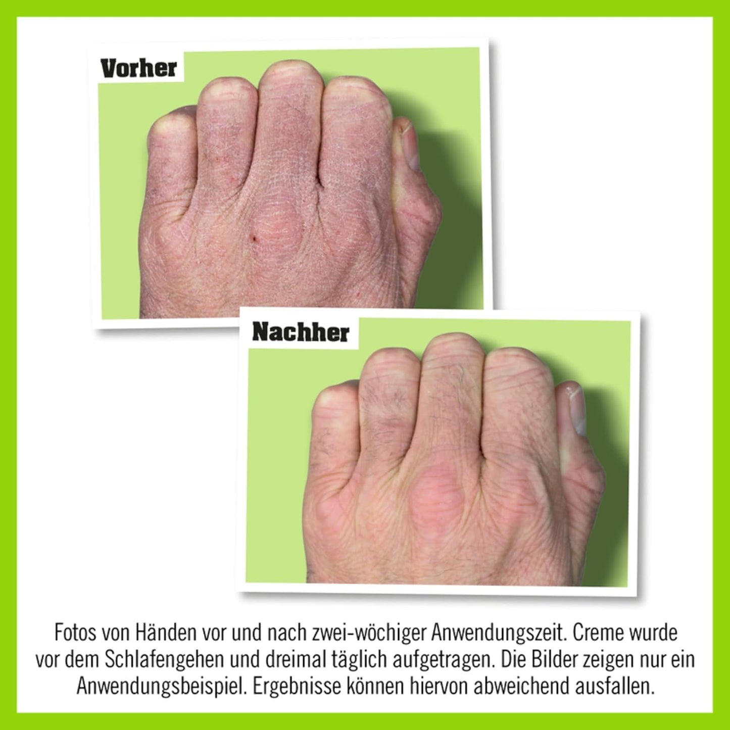 Eccema en las manos trabajadoras de O'Keeffe