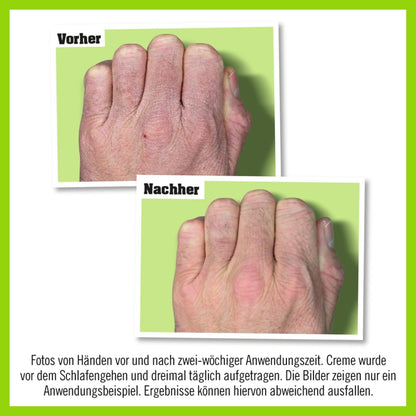 Eccema en las manos trabajadoras de O'Keeffe